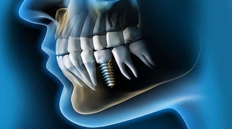 Implantes dentales de titanio: La nueva era de la biocompatibilidad