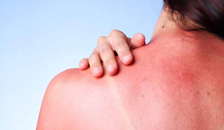 ¡Insólito! Una pastilla hecha con helecho prehistórico protege del sol