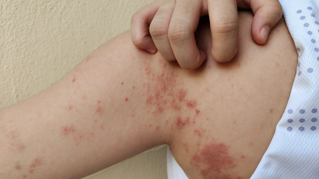 Paraguay reporta 218 casos de Lepra en 2025