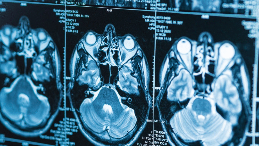 El cerebro de los hombres envejece más rápido